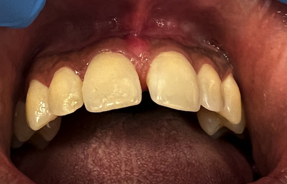 After frenectomy (tongue-tie release) at FORME Dental in Midtown Manhattan, case 1