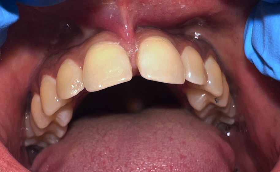 Before frenectomy (tongue-tie release) at FORME Dental in Midtown Manhattan, case 1