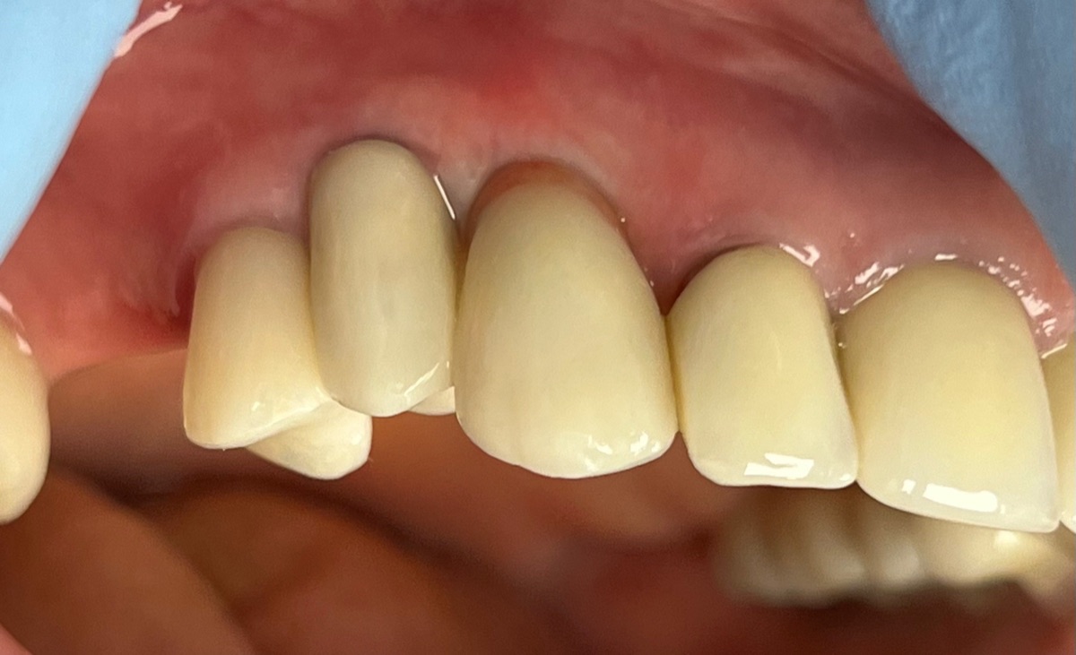 After dental implant restoration at FORME Dental in Midtown Manhattan, case 1