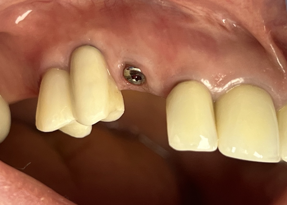Before dental implant restoration at FORME Dental in Midtown Manhattan, case 1