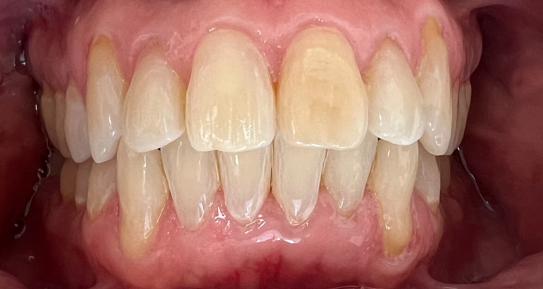 After Invisalign and orthodontic treatment at FORME Dental in Midtown Manhattan, case 1