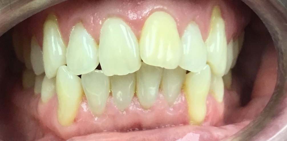 Before Invisalign and orthodontic treatment at FORME Dental in Midtown Manhattan, case 1