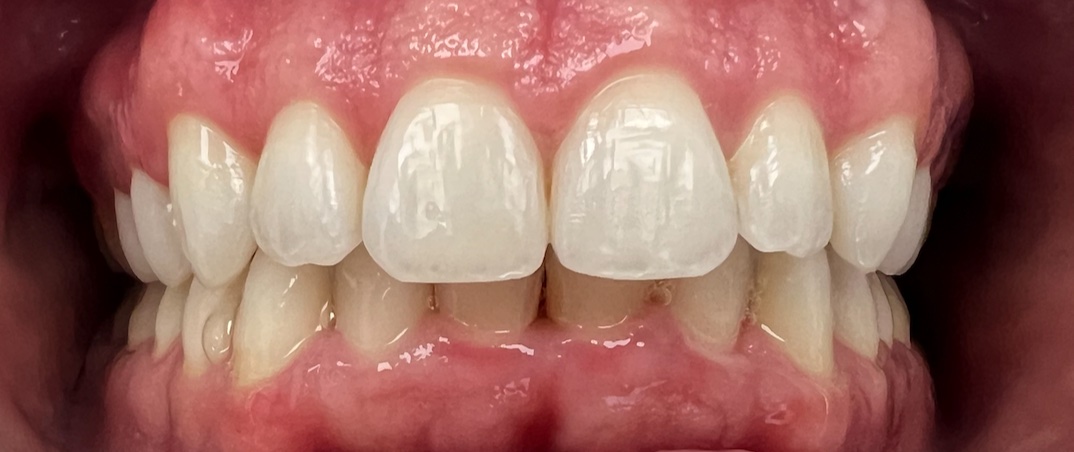 After Invisalign and orthodontic treatment at FORME Dental in Midtown Manhattan, case 2