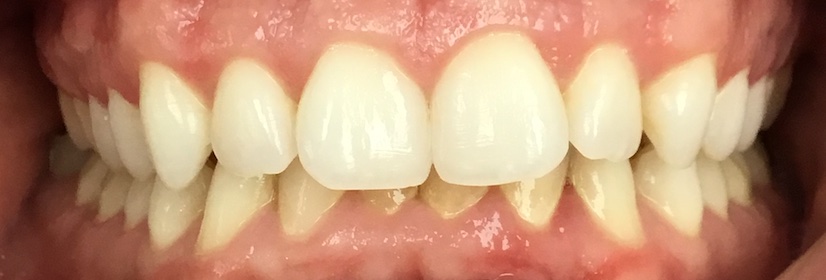 Before Invisalign and orthodontic treatment at FORME Dental in Midtown Manhattan, case 2