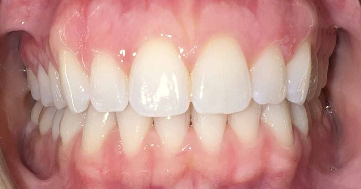 After Invisalign and orthodontic treatment at FORME Dental in Midtown Manhattan, case 3