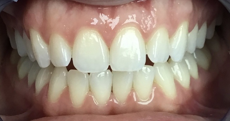 Before Invisalign and orthodontic treatment at FORME Dental in Midtown Manhattan, case 3