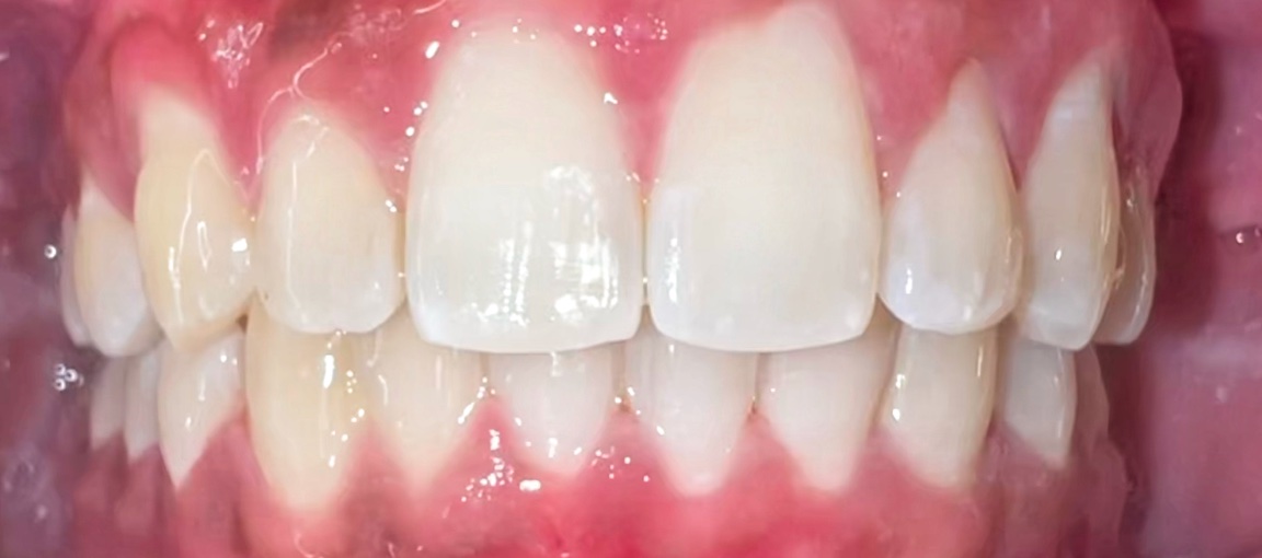 After Invisalign and orthodontic treatment at FORME Dental in Midtown Manhattan, case 4