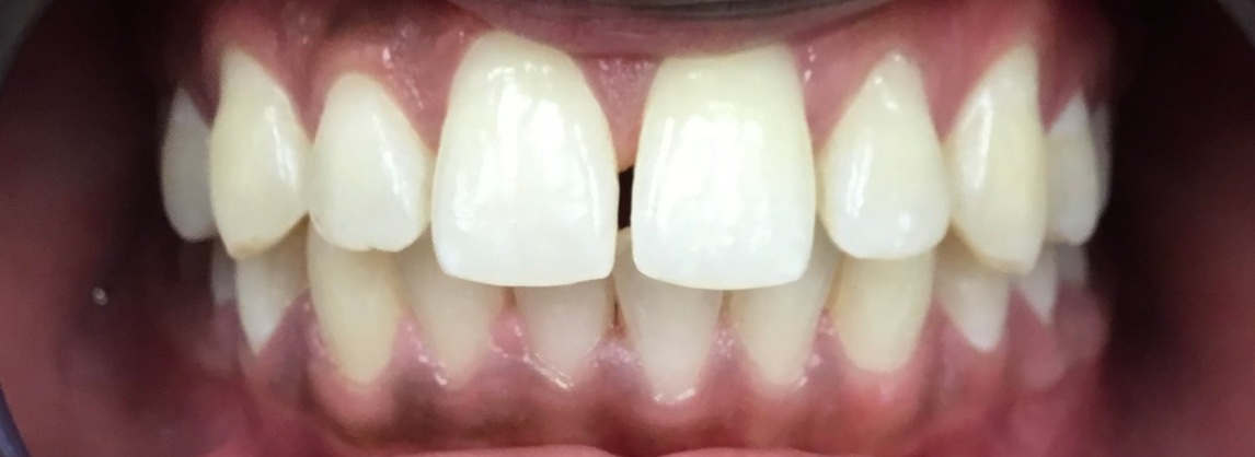 Before Invisalign and orthodontic treatment at FORME Dental in Midtown Manhattan, case 4