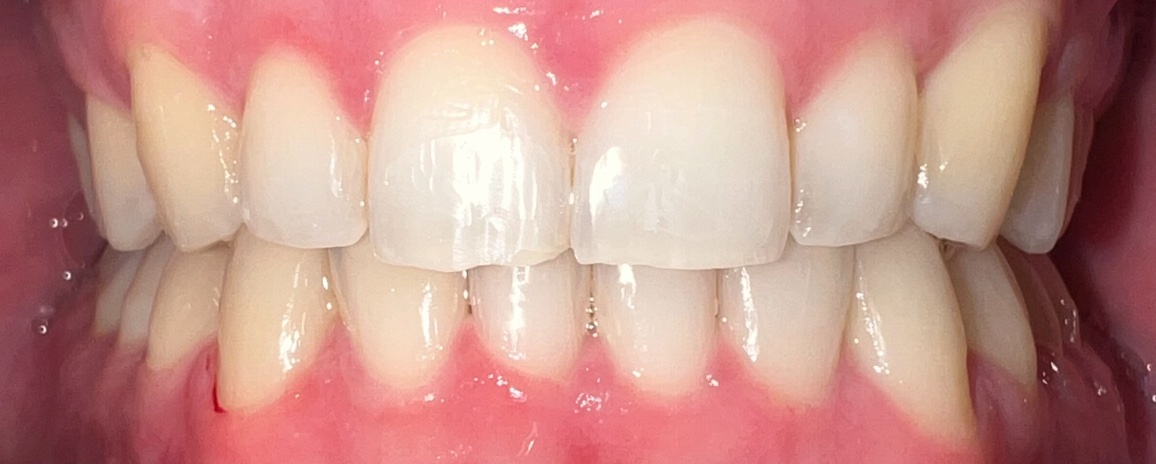 After Invisalign and orthodontic treatment at FORME Dental in Midtown Manhattan, case 5