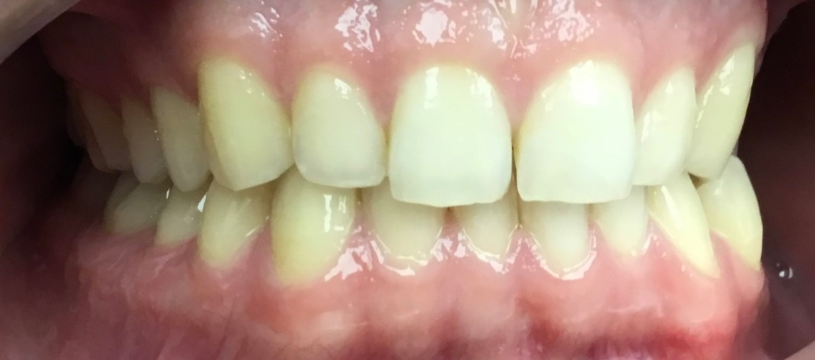 Before Invisalign and orthodontic treatment at FORME Dental in Midtown Manhattan, case 5
