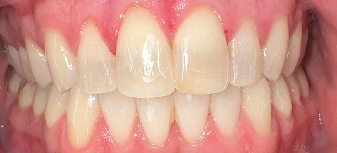 After Invisalign and orthodontic treatment at FORME Dental in Midtown Manhattan, case 6