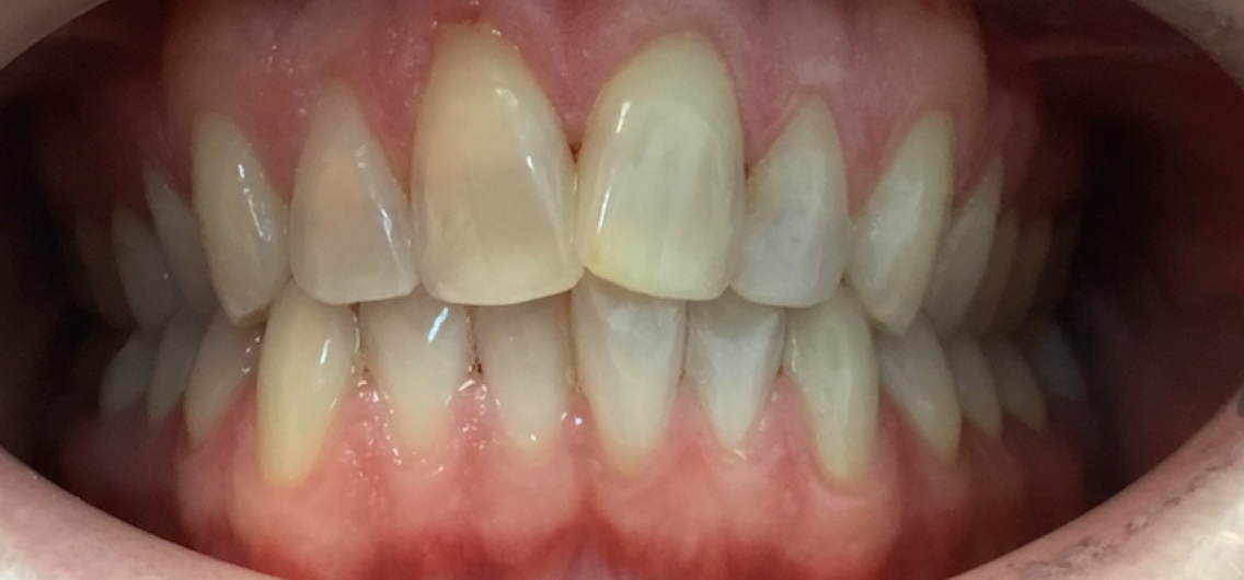 Before Invisalign and orthodontic treatment at FORME Dental in Midtown Manhattan, case 6