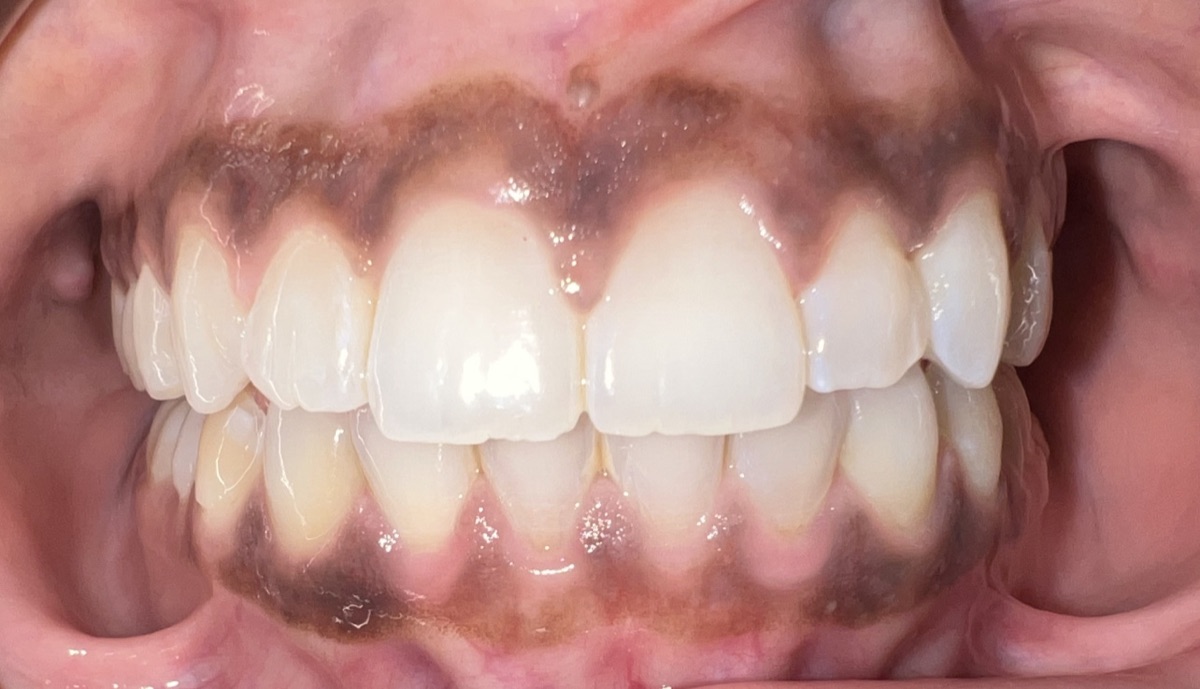 After Invisalign and orthodontic treatment at FORME Dental in Midtown Manhattan, case 7