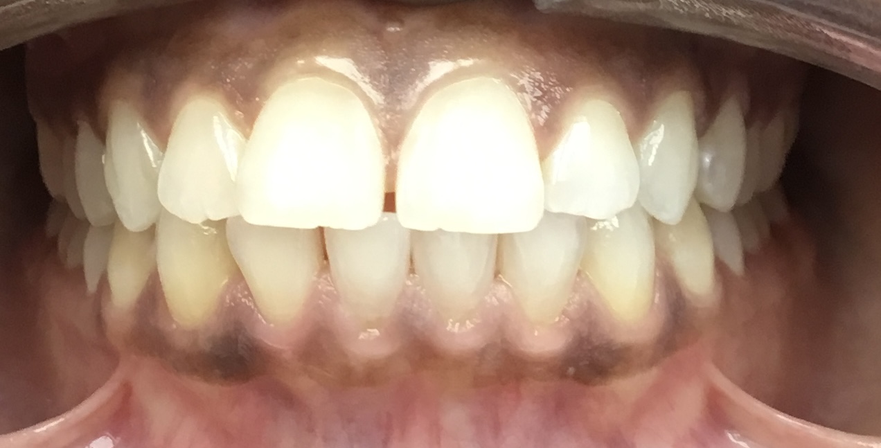 Before Invisalign and orthodontic treatment at FORME Dental in Midtown Manhattan, case 7
