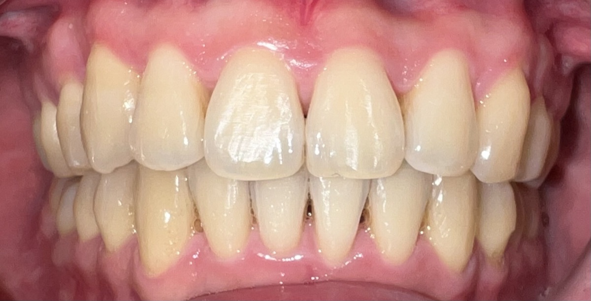 After Invisalign and orthodontic treatment at FORME Dental in Midtown Manhattan, case 8