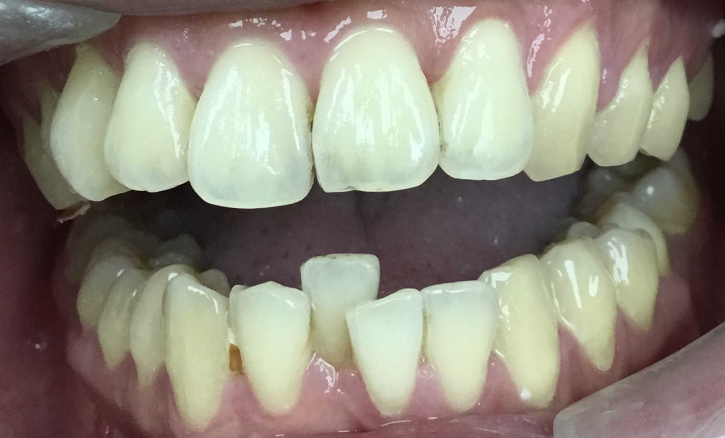 Before Invisalign and orthodontic treatment at FORME Dental in Midtown Manhattan, case 8