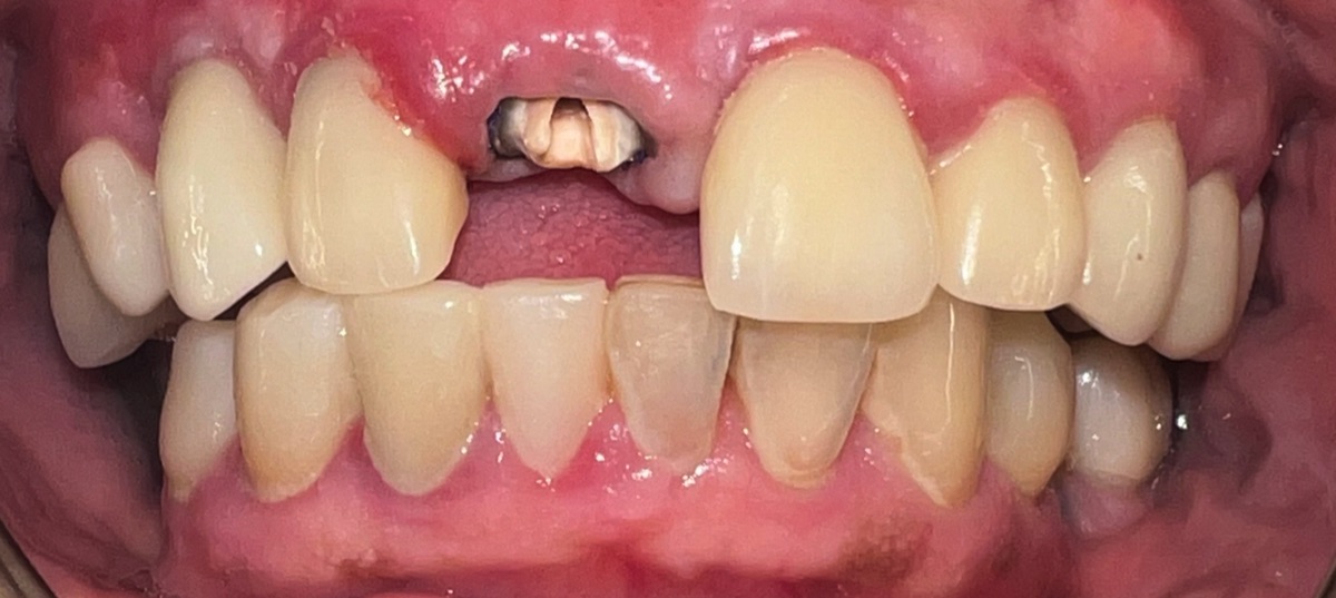 Before full smile restoration at FORME Dental in Midtown Manhattan, case 1