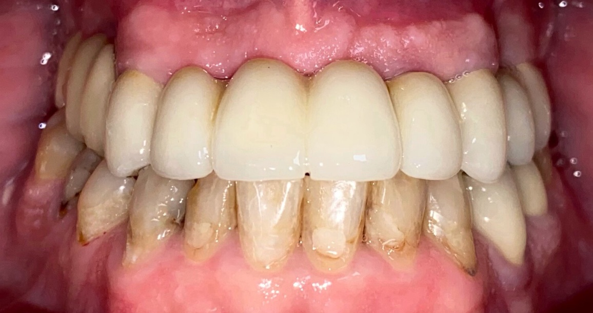 After full smile restoration at FORME Dental in Midtown Manhattan, case 2