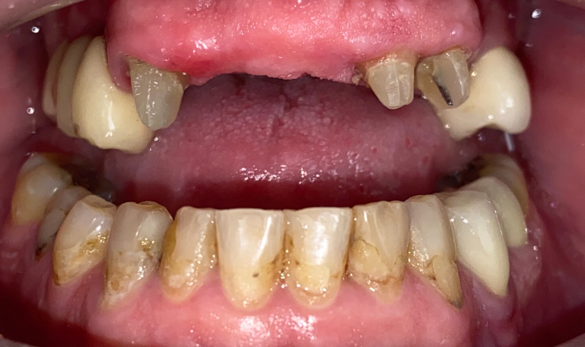 Before full smile restoration at FORME Dental in Midtown Manhattan, case 2