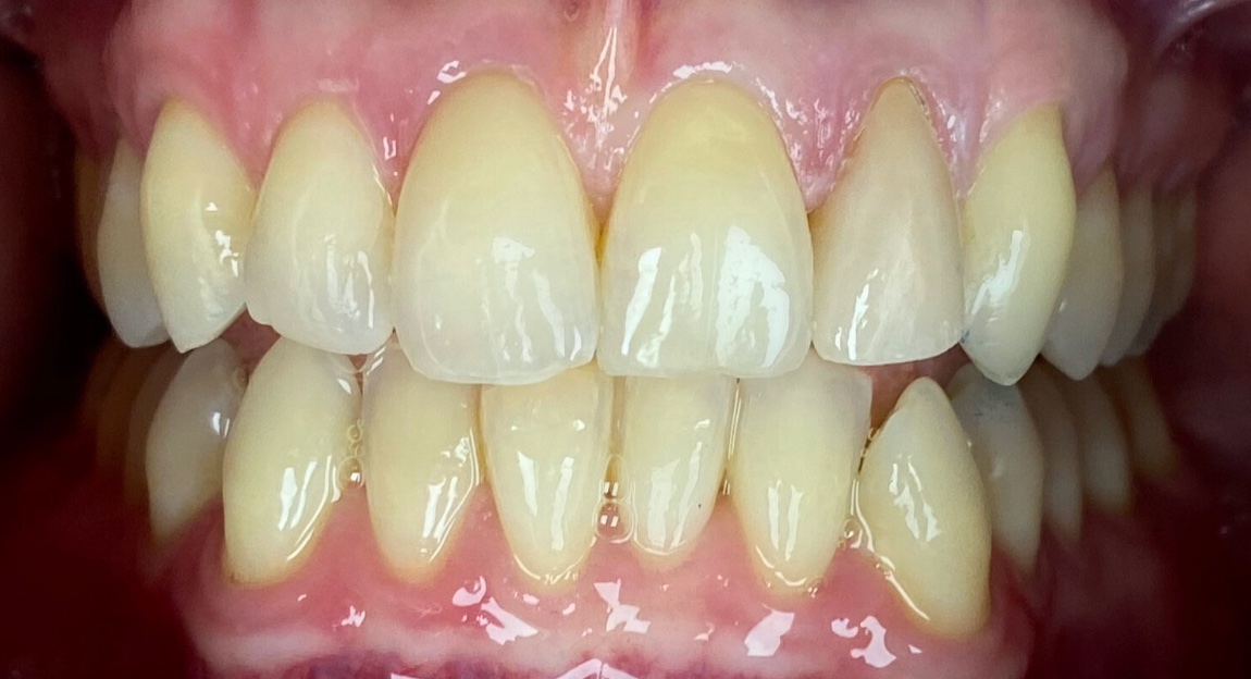 After full smile restoration at FORME Dental in Midtown Manhattan, case 3