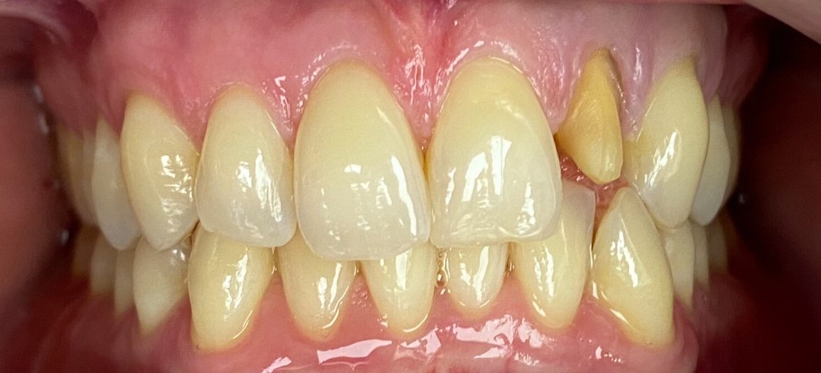 Before full smile restoration at FORME Dental in Midtown Manhattan, case 3