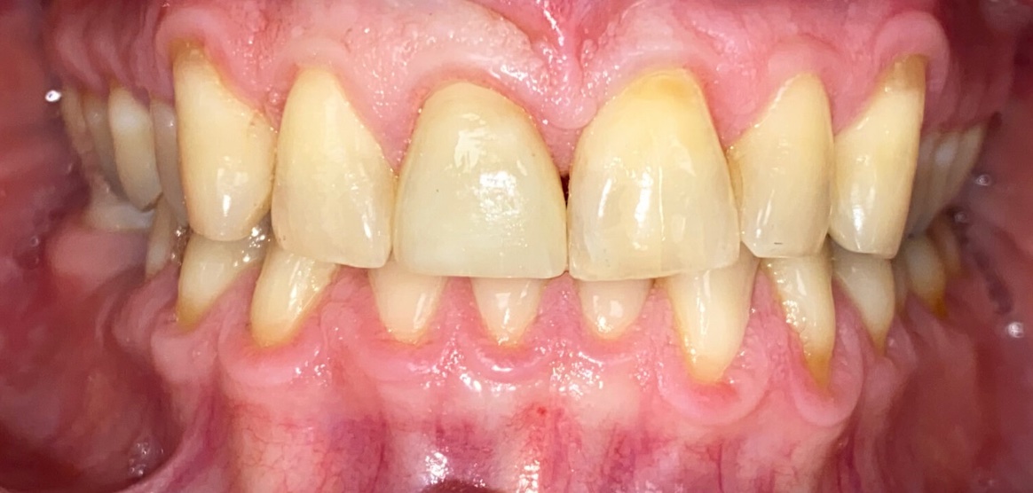 After full smile restoration at FORME Dental in Midtown Manhattan, case 5