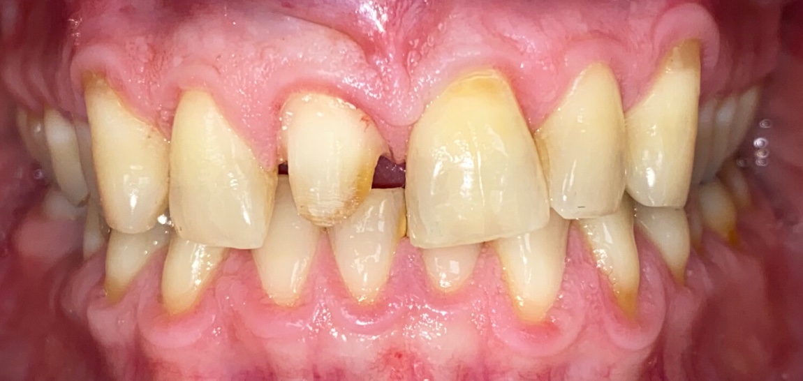 Before full smile restoration at FORME Dental in Midtown Manhattan, case 5