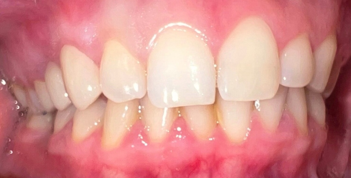 After full smile restoration at FORME Dental in Midtown Manhattan, case 6