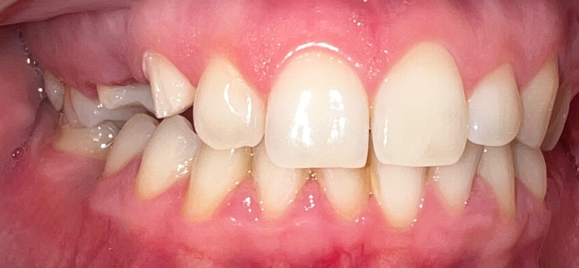 Before full smile restoration at FORME Dental in Midtown Manhattan, case 6