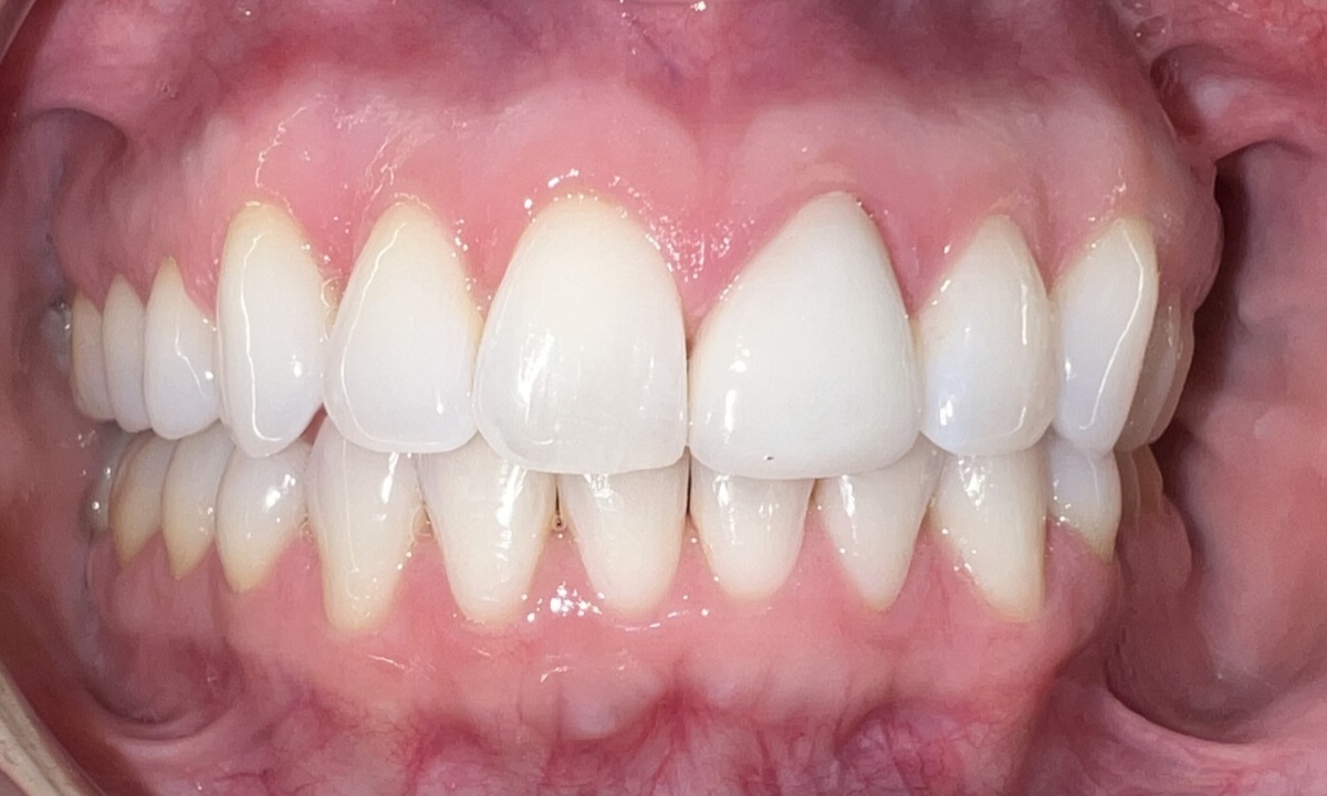 After full smile restoration at FORME Dental in Midtown Manhattan, case 7
