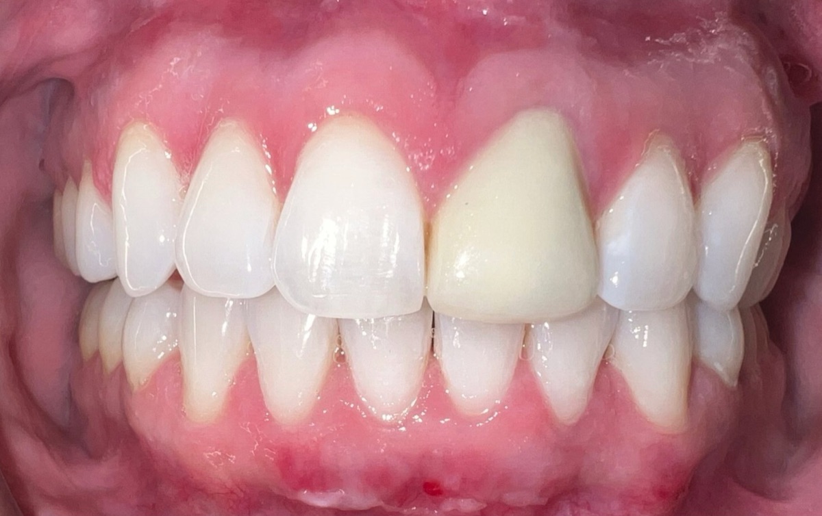 Before full smile restoration at FORME Dental in Midtown Manhattan, case 7