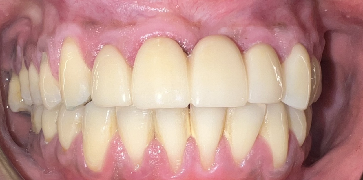 After full smile restoration at FORME Dental in Midtown Manhattan, case 8