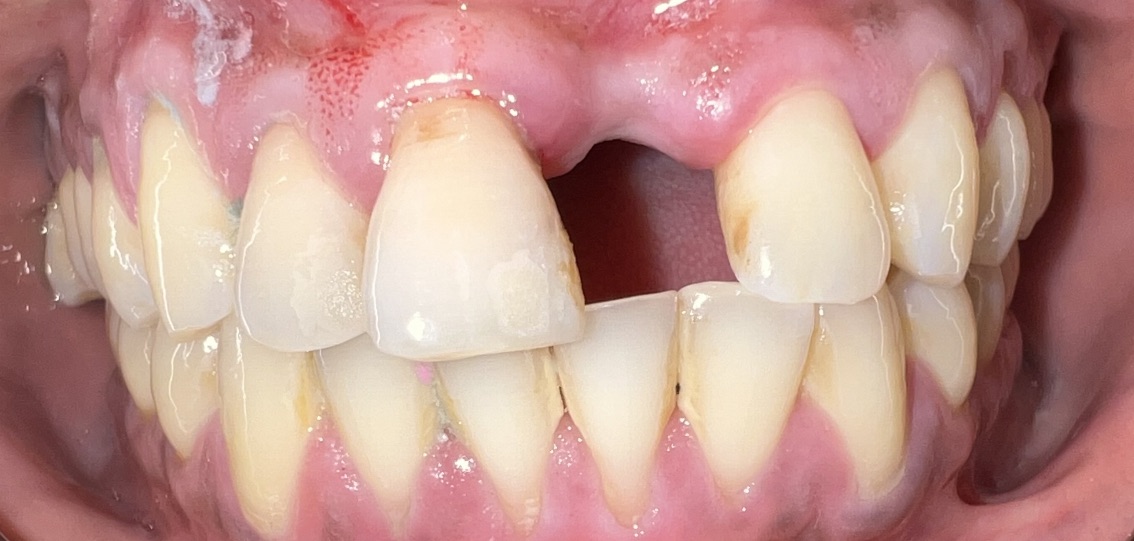 Before full smile restoration at FORME Dental in Midtown Manhattan, case 8