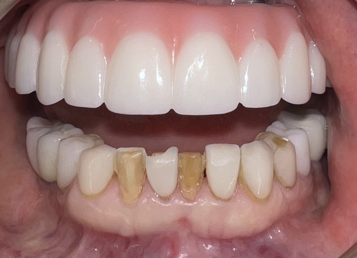 Before porcelain veneers at FORME Dental in Midtown Manhattan, case 1