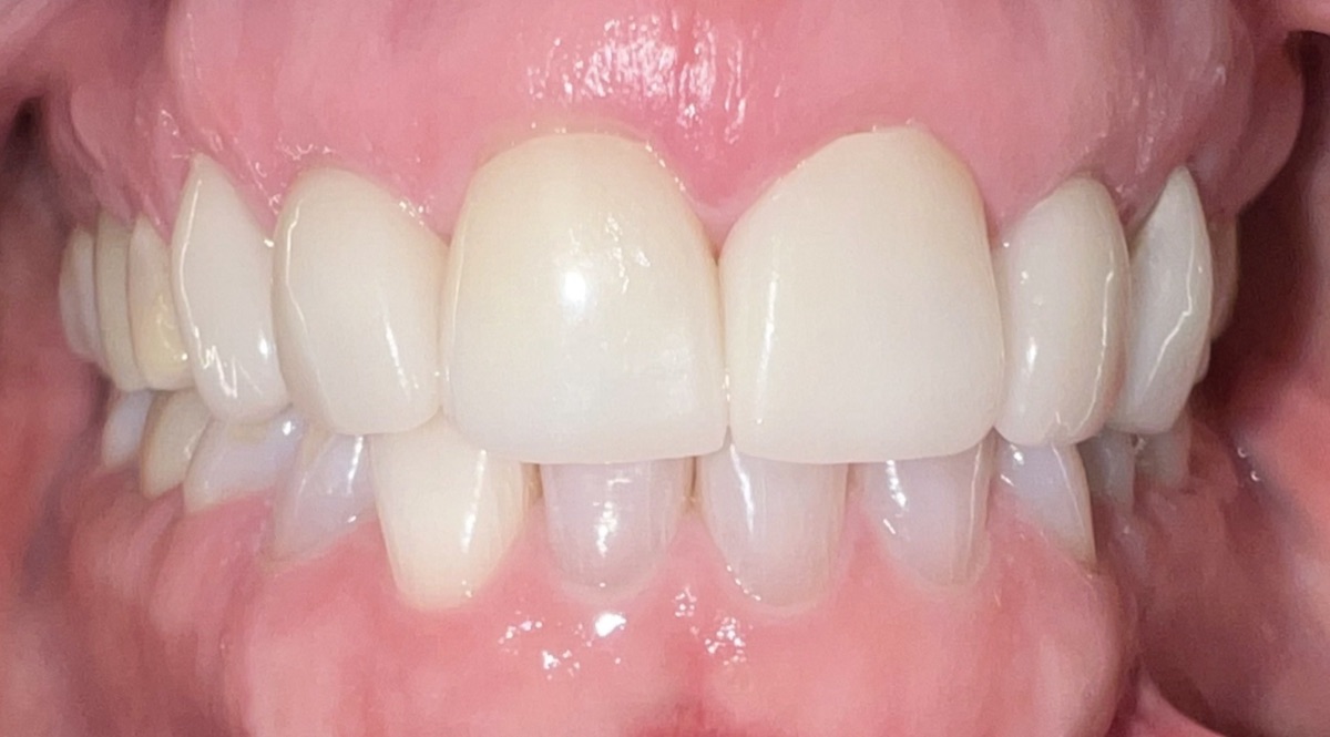 After porcelain veneers at FORME Dental in Midtown Manhattan, case 2