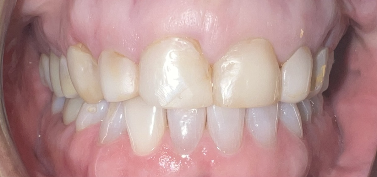 Before porcelain veneers at FORME Dental in Midtown Manhattan, case 2