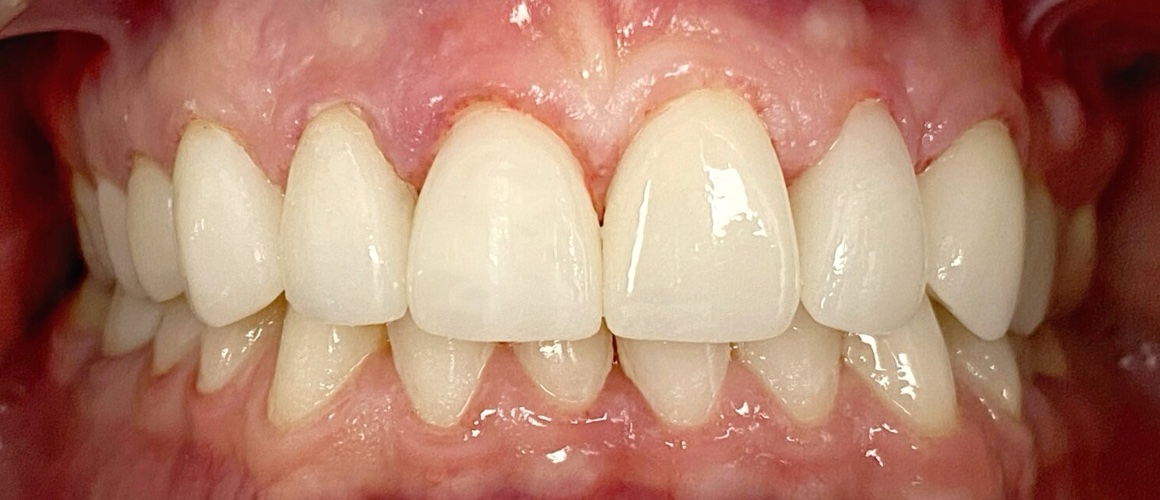 After porcelain veneers at FORME Dental in Midtown Manhattan, case 3