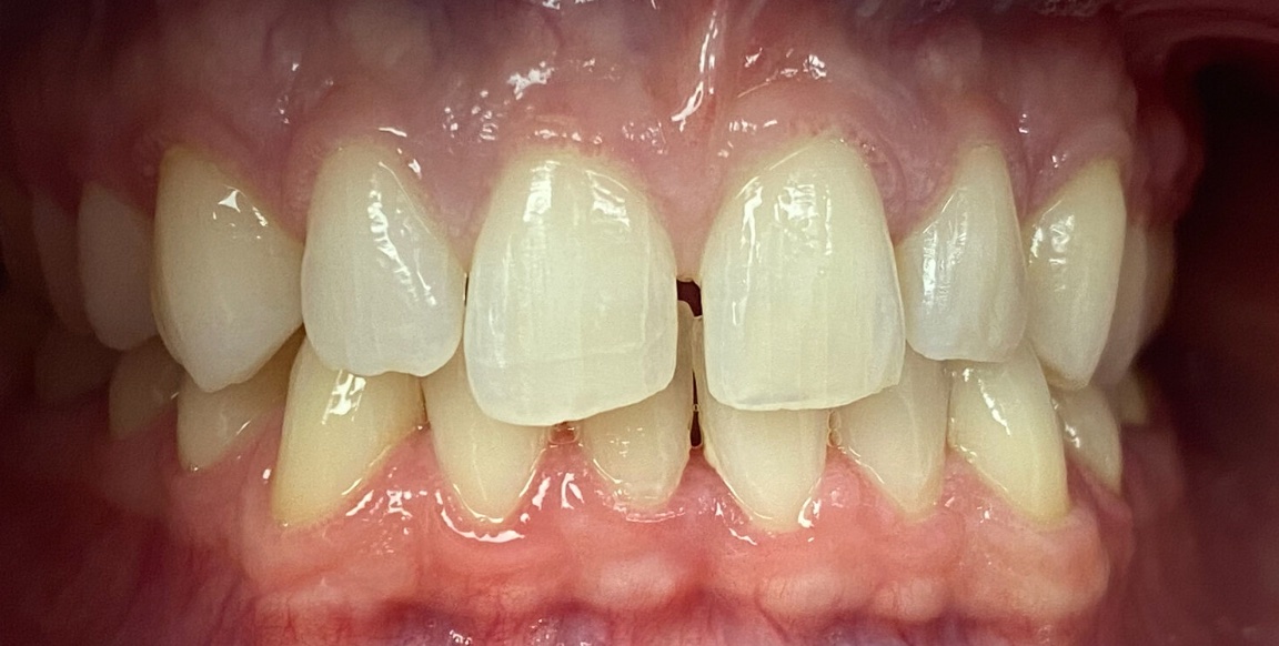 Before porcelain veneers at FORME Dental in Midtown Manhattan, case 3