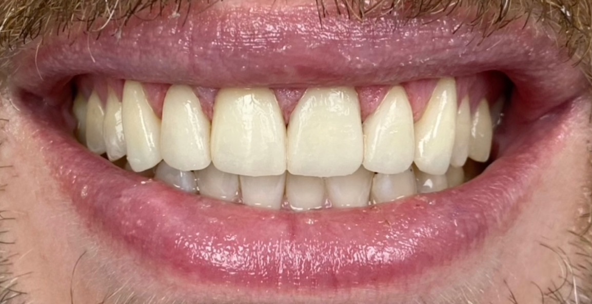 After porcelain veneers at FORME Dental in Midtown Manhattan, case 4