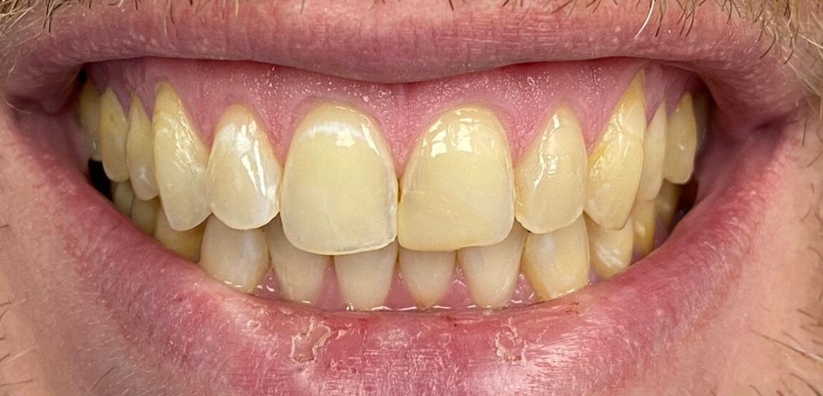 Before porcelain veneers at FORME Dental in Midtown Manhattan, case 4